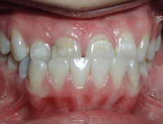 Before